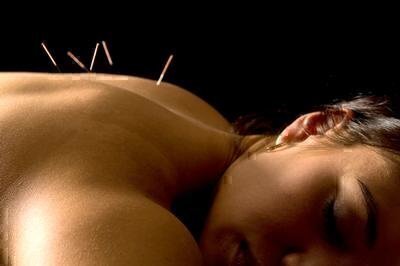 How to Choose an Acupuncturist image